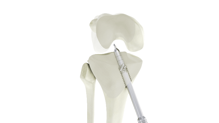 Tunnel Tibial technique DT4