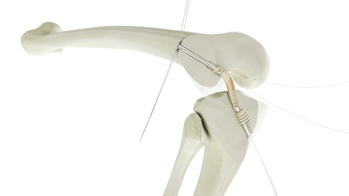 Vérouillage Tibial